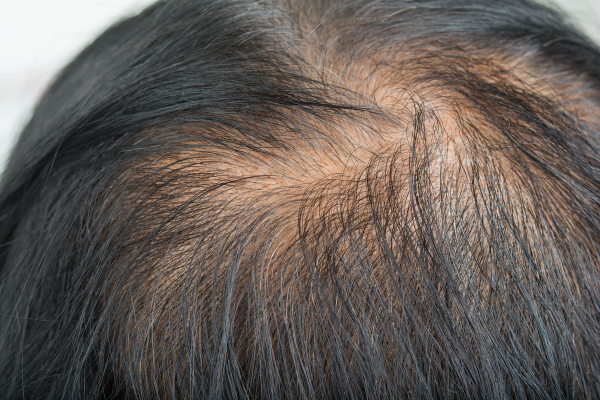 Thin  hair and scalp  and broken hair