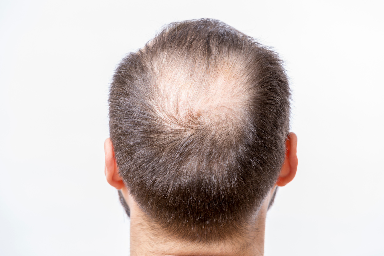 Bald man has a problem of head baldness and hair loss